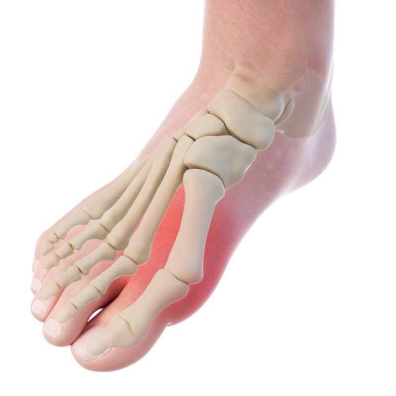 Hallux rigidus Kandler Orthopädie